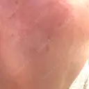 リジュラン 小木曽クリニック DAY 1 サムネイル用