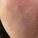 リジュラン 小木曽クリニック DAY 1 サムネイル用