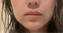 ボトックス（あご） / ボトックス（エラ・小顔） / 脂肪溶解注射（顔） / ボトックス（人中） Kinshicho Beauty Clinic （錦糸町ビューティークリニック） AFTER サムネイル用