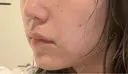 ボトックス（あご） / ボトックス（エラ・小顔） / 脂肪溶解注射（顔） / ボトックス（人中） Kinshicho Beauty Clinic （錦糸町ビューティークリニック） DAY 21 サムネイル用