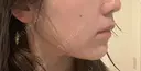 ボトックス（あご） / ボトックス（エラ・小顔） / 脂肪溶解注射（顔） / ボトックス（人中） Kinshicho Beauty Clinic （錦糸町ビューティークリニック） DAY 21 サムネイル用