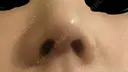 その他（鼻） / 軟骨移植 / 骨切幅寄せ / 鼻柱挙上 LUHO（ルホ）美容外科 DAY 6 サムネイル用