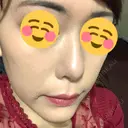 骨切り（あご） / 脂肪吸引（顔） / セットバック / ルフォー+ssro（両あご) リッツ美容外科 東京院 AFTER サムネイル用