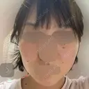 RF（高周波）たるみ治療 ルラ美容クリニック 福岡本院 DAY 8 サムネイル用