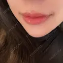 ヒアルロン酸注入（唇） AZ BEAUTY CLINIC DAY 8 サムネイル用