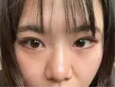 二重埋没 / 隆鼻術 / 鼻尖形成（切開） / 小鼻縮小（切開） / 軟骨移植 R Beauty CLINIC 名古屋院 AFTER サムネイル用