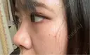 二重埋没 / 隆鼻術 / 鼻尖形成（切開） / 小鼻縮小（切開） / 軟骨移植 R Beauty CLINIC 名古屋院 DAY 238 サムネイル用