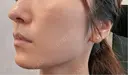 糸リフト 目白ホワイトクリニック AFTER サムネイル用