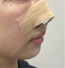鼻尖形成（切開） / 鼻中隔延長（切開） / 軟骨移植 / 鼻孔縁下降 LIVIN CLINIC DAY 1 サムネイル用
