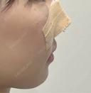 鼻尖形成（切開） / 鼻中隔延長（切開） / 軟骨移植 / 鼻孔縁下降 LIVIN CLINIC DAY 1 サムネイル用