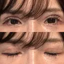 二重切開 / 眼瞼下垂（切開） / その他（目元） / 目尻切開 / タレ目形成・グラマラスライン（切開） オーキッド美容クリニック東京御徒町 DAY 28 サムネイル用
