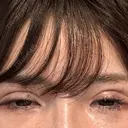 二重切開 / 眼瞼下垂（切開） / その他（目元） / 目尻切開 / タレ目形成・グラマラスライン（切開） オーキッド美容クリニック東京御徒町 DAY 28 サムネイル用