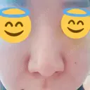 鼻孔縁挙上 / その他（鼻） シエルクリニック DAY 6 サムネイル用