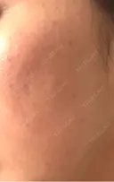 肌育注射（ジュベルックなど） / その他（肌） ゆきスキンクリニック 東池袋 DAY 1 サムネイル用
