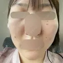 RF（高周波）たるみ治療 ルラ美容クリニック 福岡本院 DAY 9 サムネイル用