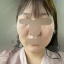 RF（高周波）たるみ治療 ルラ美容クリニック 福岡本院 DAY 10 サムネイル用