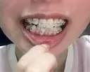 矯正（ワイヤー） X CLINIC 銀座院 DAY 50 サムネイル用