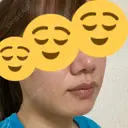 小鼻縮小（非切開） / ボトックス（口角） 形成外科と美容外科のクリニック池袋 DAY 0 サムネイル用