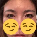 二重埋没 / 目元修正 BELINDA CLINIC（ベリンダクリニック）岡山院 DAY 76 サムネイル用