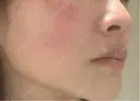 美肌レーザー / 美白レーザー / YAGレーザー / レーザーフェイシャル / 赤み除去レーザー AI Beauty Clinic （エーアイ美容クリニック） DAY 0 サムネイル用