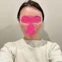糸リフト / ヒアルロン酸注入（頬） EMMO FACE CLINIC 東京三田院 AFTER サムネイル用