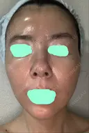 その他（肌） / ダーマペン スキンリファインクリニック銀座 AFTER サムネイル用