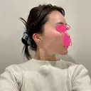 糸リフト / ヒアルロン酸注入（頬） EMMO FACE CLINIC 東京三田院 DAY 31 サムネイル用