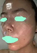 その他（肌） / ダーマペン スキンリファインクリニック銀座 DAY 7 サムネイル用