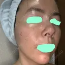 その他（肌） / ダーマペン スキンリファインクリニック銀座 DAY 7 サムネイル用