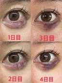 目尻切開 / タレ目形成・グラマラスライン（埋没） / ヒアルロン酸注入（涙袋） / ボトックス（口角） LOUIS CLINIC 二子玉川院【ルイクリニック】 DAY 18 サムネイル用