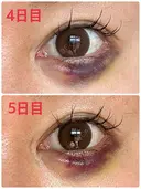 目尻切開 / タレ目形成・グラマラスライン（埋没） / ヒアルロン酸注入（涙袋） / ボトックス（口角） LOUIS CLINIC 二子玉川院【ルイクリニック】 DAY 19 サムネイル用