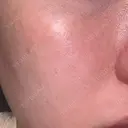 フォトRF 共立美容外科 仙台院 AFTER サムネイル用