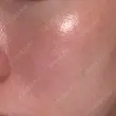 フォトRF 共立美容外科 仙台院 DAY 10 サムネイル用