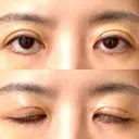 眼瞼下垂（切開） WOM CLINIC GINZA （ワム クリニック ギンザ） DAY 7 サムネイル用