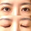 眼瞼下垂（切開） WOM CLINIC GINZA （ワム クリニック ギンザ） DAY 8 サムネイル用