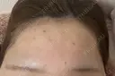 ボトックス（あご） / ボトックス（口角） / ボトックス（眉間） / ボトックス（額） REDLINE CLINIC DAY 0 サムネイル用