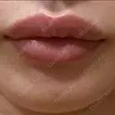 ヒアルロン酸注入（唇） アネシス美容クリニック AFTER サムネイル用