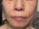 ショッピングリフト Natural Skin Clinic 笹塚院 DAY 18 サムネイル用