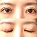 眼瞼下垂（切開） WOM CLINIC GINZA （ワム クリニック ギンザ） DAY 9 サムネイル用