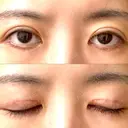 眼瞼下垂（切開） WOM CLINIC GINZA （ワム クリニック ギンザ） DAY 10 サムネイル用