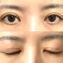 眼瞼下垂（切開） WOM CLINIC GINZA （ワム クリニック ギンザ） DAY 13 サムネイル用