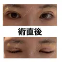 自然癒着法 / 眼瞼下垂（非切開） LUHO（ルホ）美容外科 DAY 0 サムネイル用