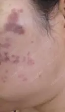 イオン導入 / ピコレーザートーニング（美白・肝斑） / ピコスポット A CLINIC（エークリニック） 横浜院 DAY 0 サムネイル用