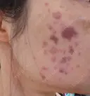 イオン導入 / ピコレーザートーニング（美白・肝斑） / ピコスポット A CLINIC（エークリニック） 横浜院 DAY 0 サムネイル用