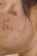 イオン導入 / ピコレーザートーニング（美白・肝斑） / ピコスポット A CLINIC（エークリニック） 横浜院 DAY 1 サムネイル用