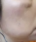 イオン導入 / ピコレーザートーニング（美白・肝斑） / ピコスポット A CLINIC（エークリニック） 横浜院 AFTER サムネイル用