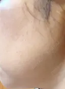 イオン導入 / ピコレーザートーニング（美白・肝斑） / ピコスポット A CLINIC（エークリニック） 横浜院 DAY 10 サムネイル用