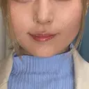 ボトックス（エラ・小顔） AYANAフィラーズクリニック 渋谷院 DAY 3 サムネイル用