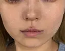 ボトックス（エラ・小顔） AYANAフィラーズクリニック 渋谷院 DAY 44 サムネイル用