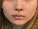 ボトックス（エラ・小顔） AYANAフィラーズクリニック 渋谷院 DAY 23 サムネイル用
